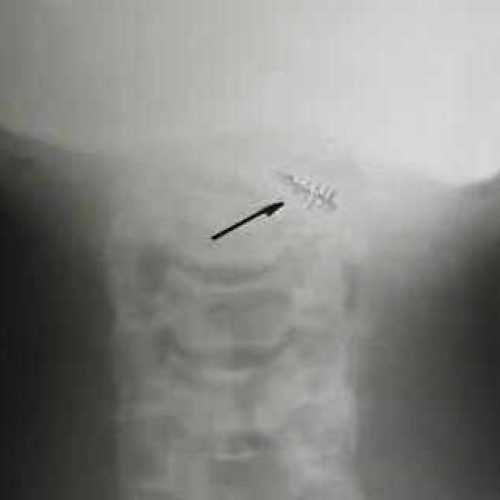 Implantes extraterrestres
